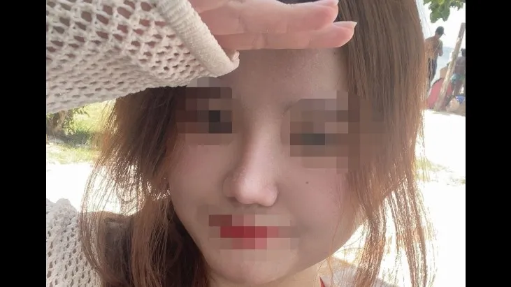 Incisional Double Eyelid Surgery, Ptosis Correction, Nasal Tip, Nasal Bridge — RE&RE PLASTIC SURGERY 6