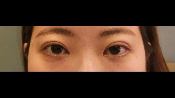 Incisional Double Eyelid Surgery, Crease lowering 1