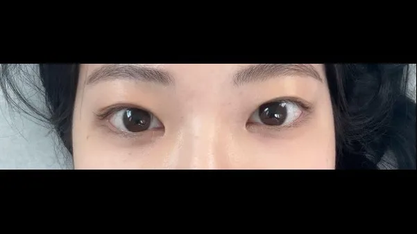 切開法(二重), ラインを低くする — RE&RE PLASTIC SURGERY 2