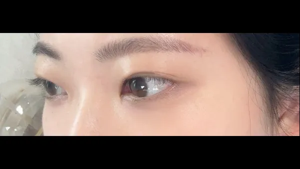 切開法(二重), ラインを低くする — RE&RE PLASTIC SURGERY 3