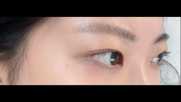 切開法(二重), ラインを低くする — RE&RE PLASTIC SURGERY 4