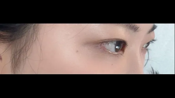 切開法(二重), ラインを低くする — RE&RE PLASTIC SURGERY 5