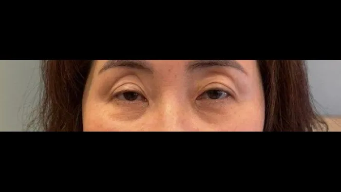 Incisional Double Eyelid Surgery, Ptosis Correction, Crease lowering, Lower Eyelid Fat Grafting — RE&RE PLASTIC SURGERY 1