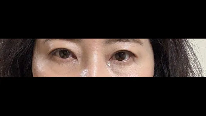 Incisional Double Eyelid Surgery, Ptosis Correction, Crease lowering, Lower Eyelid Fat Grafting 2