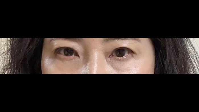 Incisional Double Eyelid Surgery, Ptosis Correction, Crease lowering, Lower Eyelid Fat Grafting — RE&RE PLASTIC SURGERY 5