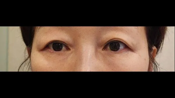 Sub-brow Lift, Full-Face Thread lift 1
