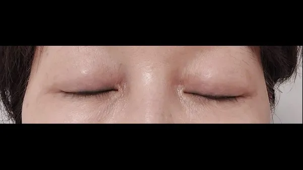 Sub-brow Lift, Full-Face Thread lift — RE&RE PLASTIC SURGERY 6