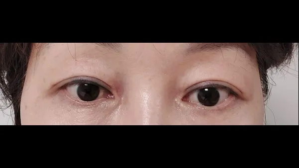Sub-brow Lift, Full-Face Thread lift — RE&RE PLASTIC SURGERY 2
