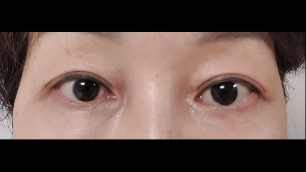 Sub-brow Lift, Full-Face Thread lift — RE&RE PLASTIC SURGERY 3