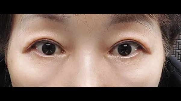 Sub-brow Lift, Full-Face Thread lift — RE&RE PLASTIC SURGERY 4