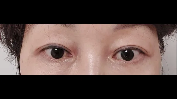 Sub-brow Lift, Full-Face Thread lift — RE&RE PLASTIC SURGERY 5