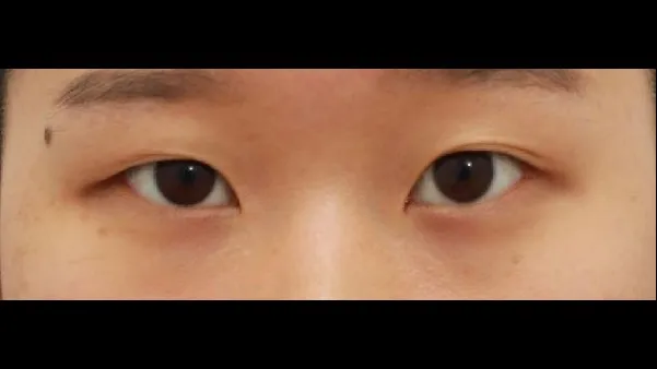 切开法(双眼皮) 1