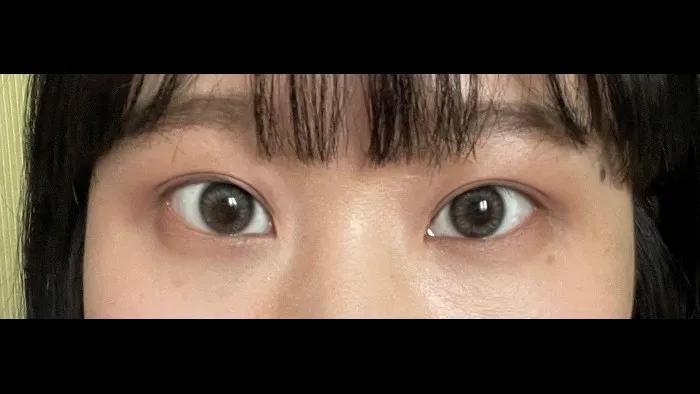 Incisional Double Eyelid Surgery — RE&RE PLASTIC SURGERY 3