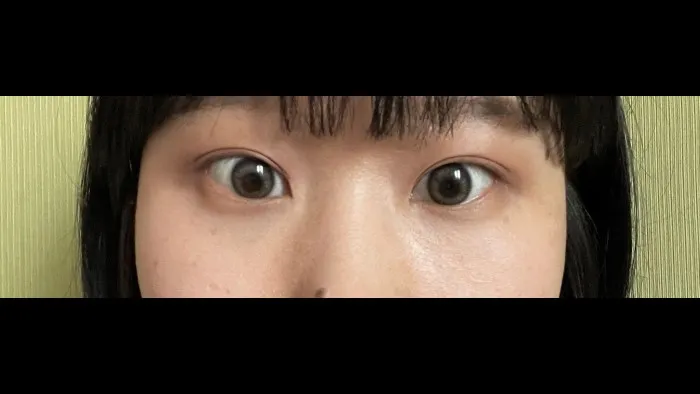 Incisional Double Eyelid Surgery — RE&RE PLASTIC SURGERY 4
