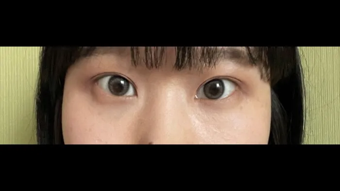 Incisional Double Eyelid Surgery — RE&RE PLASTIC SURGERY 5