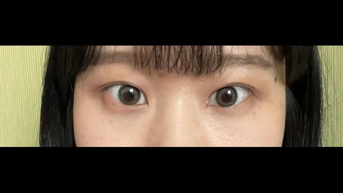 Incisional Double Eyelid Surgery — RE&RE PLASTIC SURGERY 6