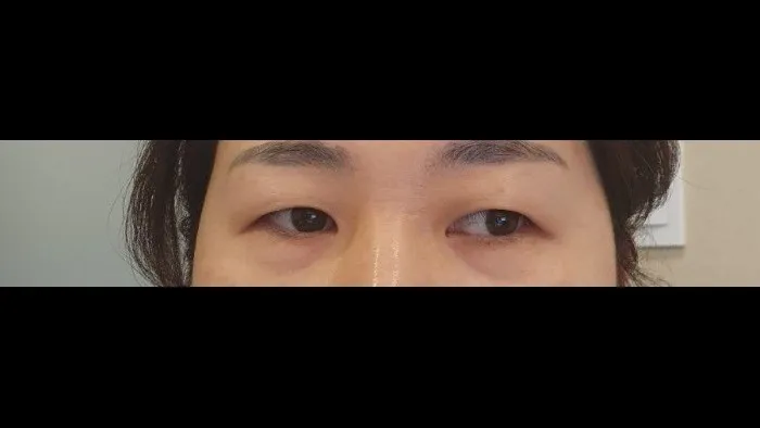 Sub-brow Lift, Ptosis Correction — RE&RE PLASTIC SURGERY 1