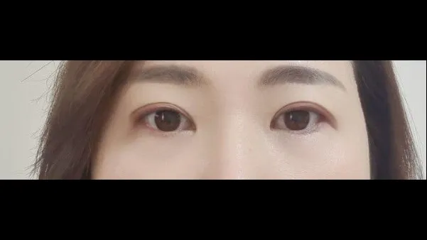 Sub-brow Lift, Ptosis Correction — RE&RE PLASTIC SURGERY 2