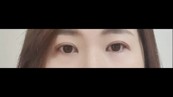 Sub-brow Lift, Ptosis Correction — RE&RE PLASTIC SURGERY 3