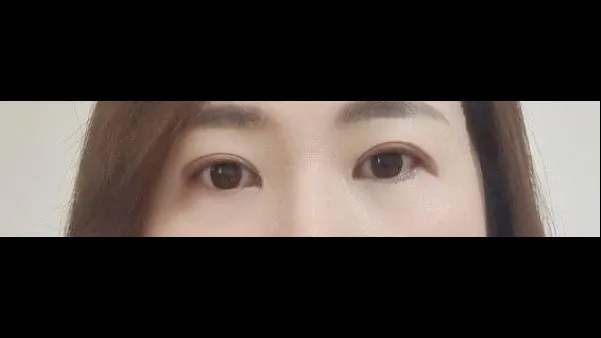Sub-brow Lift, Ptosis Correction — RE&RE PLASTIC SURGERY 4