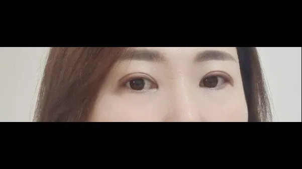 Sub-brow Lift, Ptosis Correction — RE&RE PLASTIC SURGERY 5