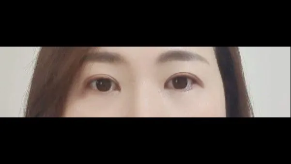 Sub-brow Lift, Ptosis Correction — RE&RE PLASTIC SURGERY 6