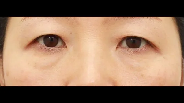 Sub-brow Lift, Lower Blepharoplasty (Aging Eye Rejuvenation) — RE&RE PLASTIC SURGERY 1