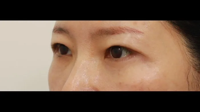Sub-brow Lift, Lower Blepharoplasty (Aging Eye Rejuvenation) — RE&RE PLASTIC SURGERY 2