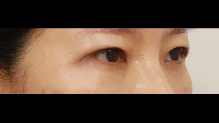 Sub-brow Lift, Lower Blepharoplasty (Aging Eye Rejuvenation) — RE&RE PLASTIC SURGERY 3