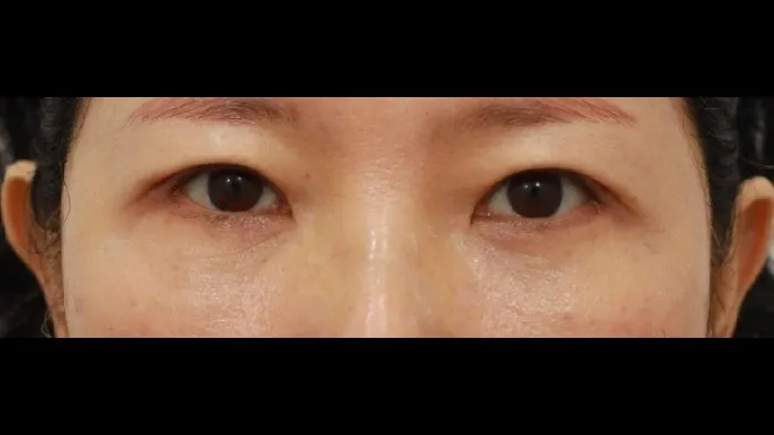 Sub-brow Lift, Lower Blepharoplasty (Aging Eye Rejuvenation) — RE&RE PLASTIC SURGERY 4