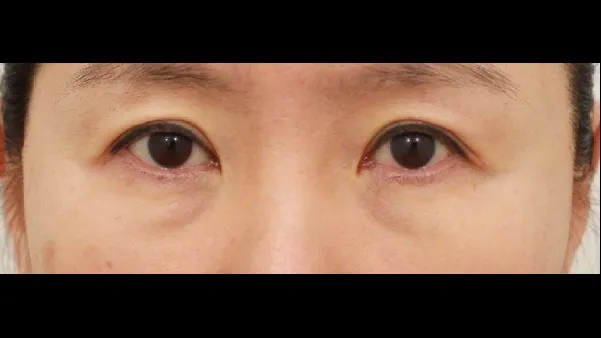 眉下提升, 眼底脂肪重排 1