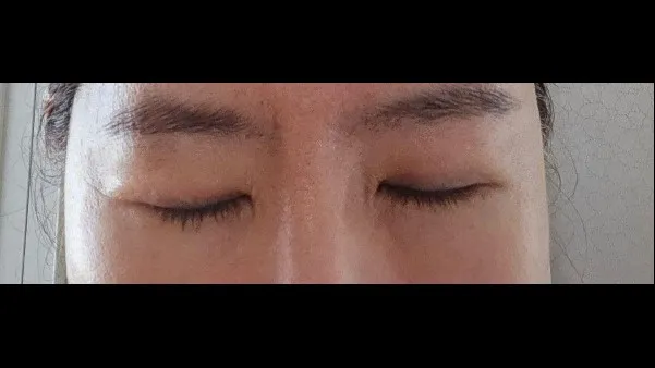 眉下リフト, 目の下脂肪再配置 — RE&RE PLASTIC SURGERY 3