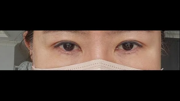 眉下リフト, 目の下脂肪再配置 — RE&RE PLASTIC SURGERY 4