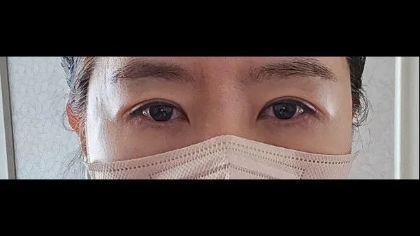 眉下リフト, 目の下脂肪再配置 — RE&RE PLASTIC SURGERY 6