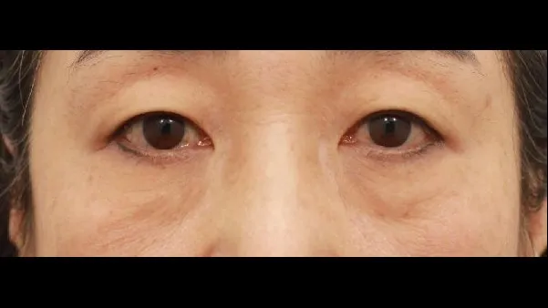 Sub-brow Lift, Lower Blepharoplasty (Aging Eye Rejuvenation), Midface Lift 1