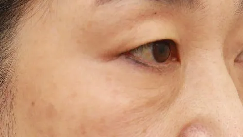 Sub-brow Lift, Lower Blepharoplasty (Aging Eye Rejuvenation), Midface Lift — RE&RE PLASTIC SURGERY 3