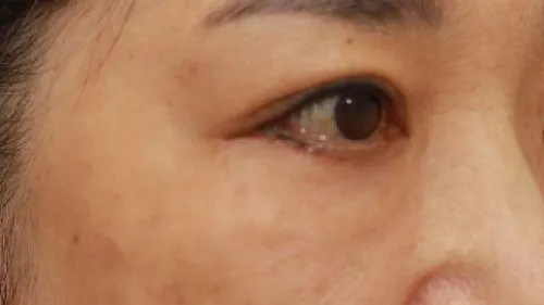 Sub-brow Lift, Lower Blepharoplasty (Aging Eye Rejuvenation), Midface Lift — RE&RE PLASTIC SURGERY 4