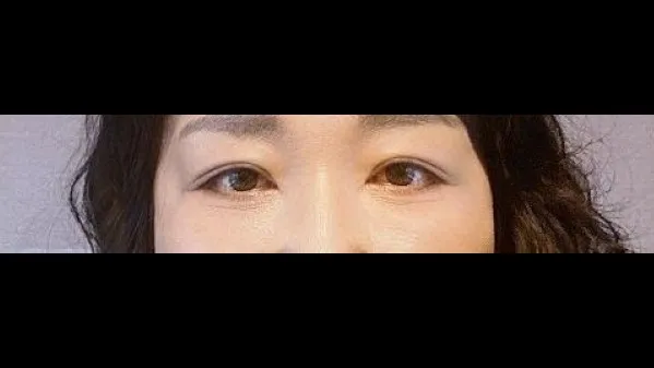 Sub-brow Lift, Lower Blepharoplasty (Aging Eye Rejuvenation), Midface Lift — RE&RE PLASTIC SURGERY 5