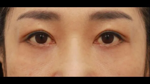 Sub-brow Lift, Lower Blepharoplasty (Aging Eye Rejuvenation), Midface Lift 2