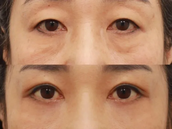 Sub-brow Lift, Lower Blepharoplasty (Aging Eye Rejuvenation), Midface Lift — RE&RE PLASTIC SURGERY 6
