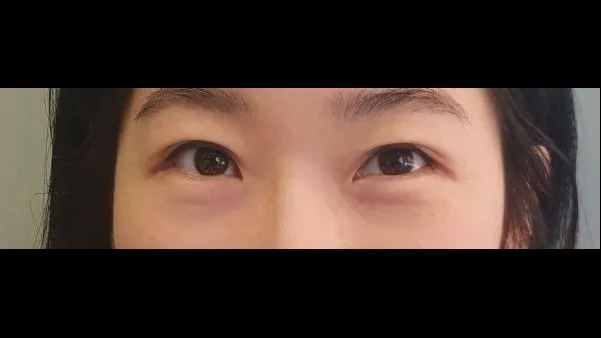 Incisional Double Eyelid Surgery, Revision ptosis correction, Ptosis Correction — RE&RE PLASTIC SURGERY 1