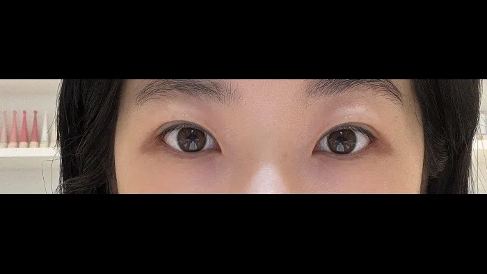 Incisional Double Eyelid Surgery, Revision ptosis correction, Ptosis Correction — RE&RE PLASTIC SURGERY 3