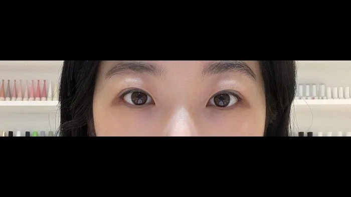 Incisional Double Eyelid Surgery, Revision ptosis correction, Ptosis Correction — RE&RE PLASTIC SURGERY 4