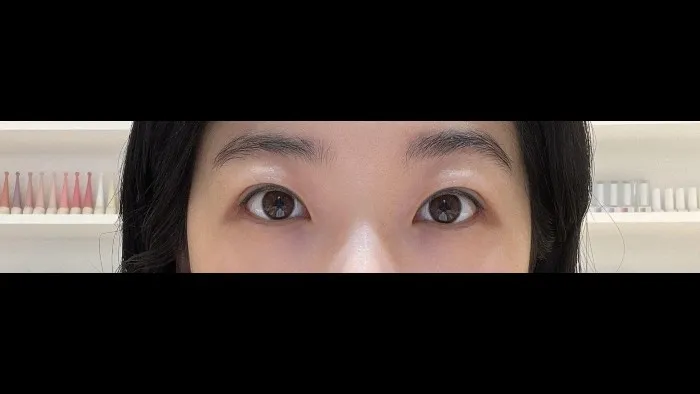 Incisional Double Eyelid Surgery, Revision ptosis correction, Ptosis Correction — RE&RE PLASTIC SURGERY 5