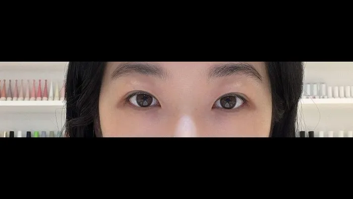 Incisional Double Eyelid Surgery, Revision ptosis correction, Ptosis Correction — RE&RE PLASTIC SURGERY 6