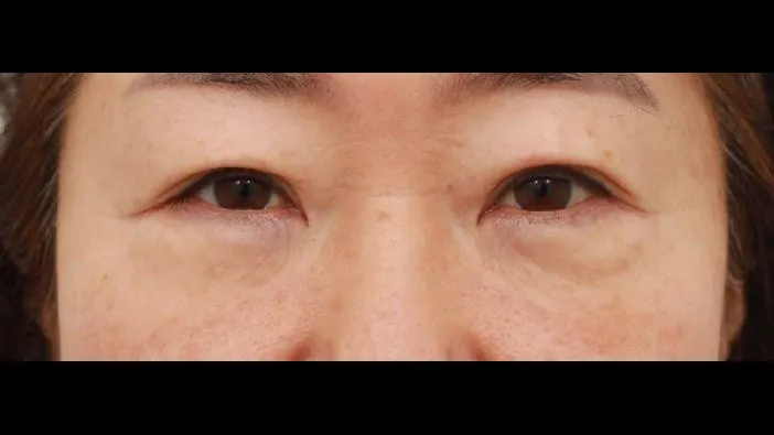 Sub-brow Lift, Lower Blepharoplasty (Aging Eye Rejuvenation), Midface Lift 1