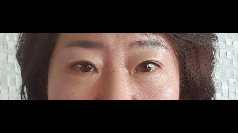 Sub-brow Lift, Lower Blepharoplasty (Aging Eye Rejuvenation), Midface Lift — RE&RE PLASTIC SURGERY 2