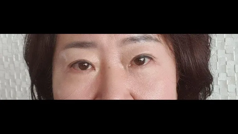 Sub-brow Lift, Lower Blepharoplasty (Aging Eye Rejuvenation), Midface Lift — RE&RE PLASTIC SURGERY 4