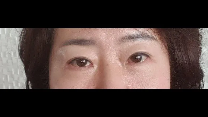 Sub-brow Lift, Lower Blepharoplasty (Aging Eye Rejuvenation), Midface Lift — RE&RE PLASTIC SURGERY 5