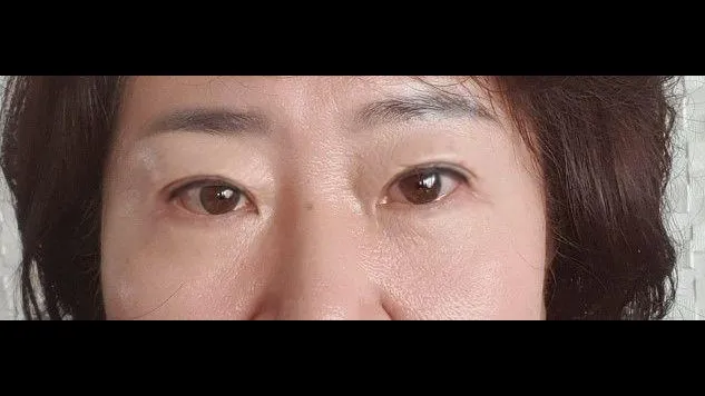 Sub-brow Lift, Lower Blepharoplasty (Aging Eye Rejuvenation), Midface Lift — RE&RE PLASTIC SURGERY 6